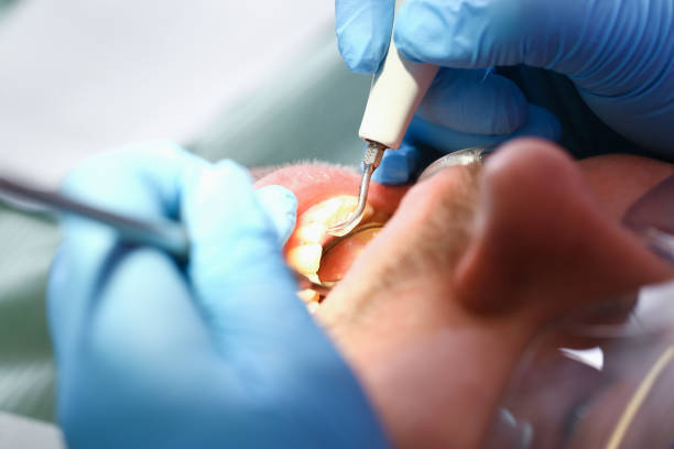 Best Emergency Wisdom Teeth Removal in Draper, UT