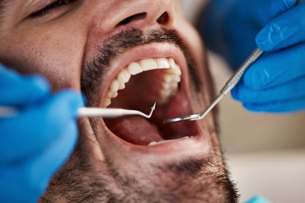 Best Emergency Treatment for Dental Infections or Abscesses in Draper, UT